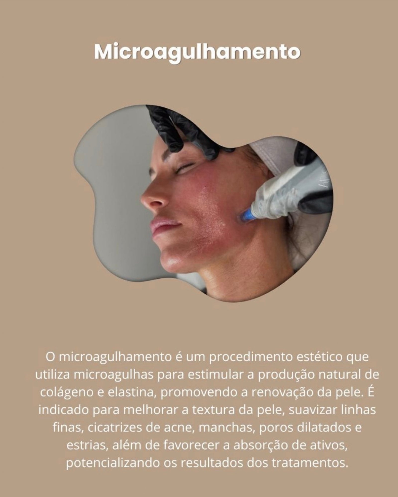 Microagulhamento